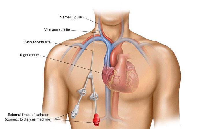 Temporary Hemodialysis Catheter - Image 5